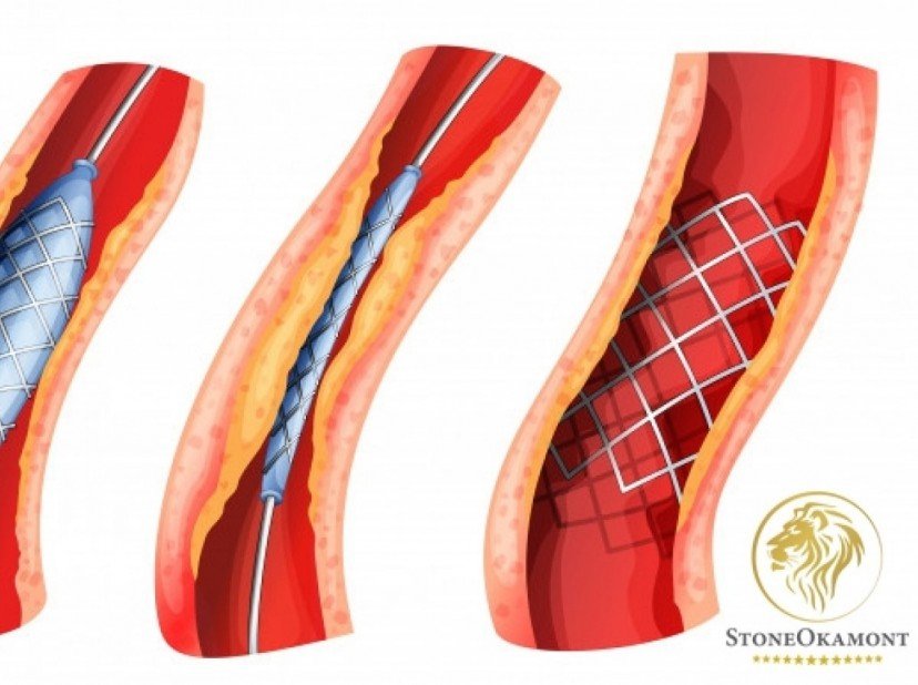 Como registrar Stent coronário na Anvisa