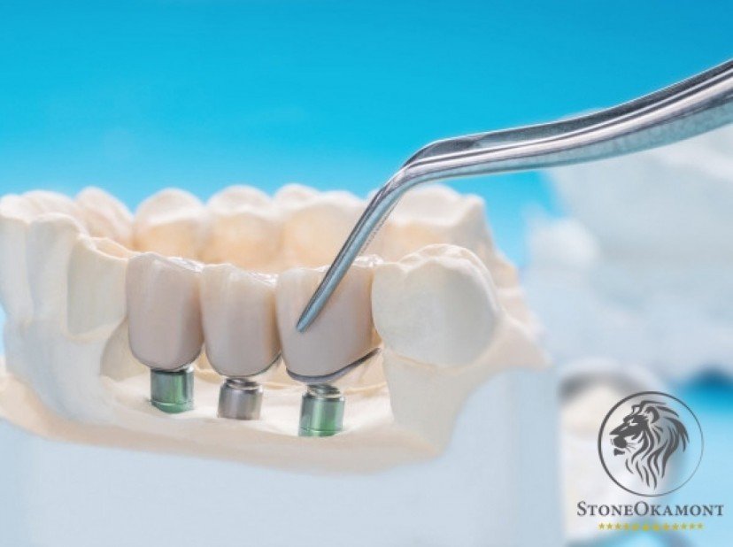 Como registrar implante dentário na Anvisa