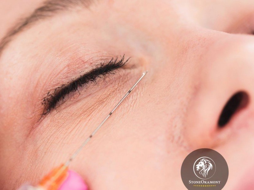 Como registrar cânula para procedimento estético?